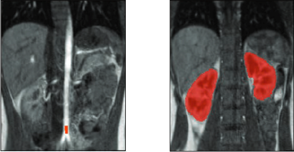 Rys. 2. Przykładowe obrazy DCE-MRI oraz wynik wstępnej segmentacji nerek.
